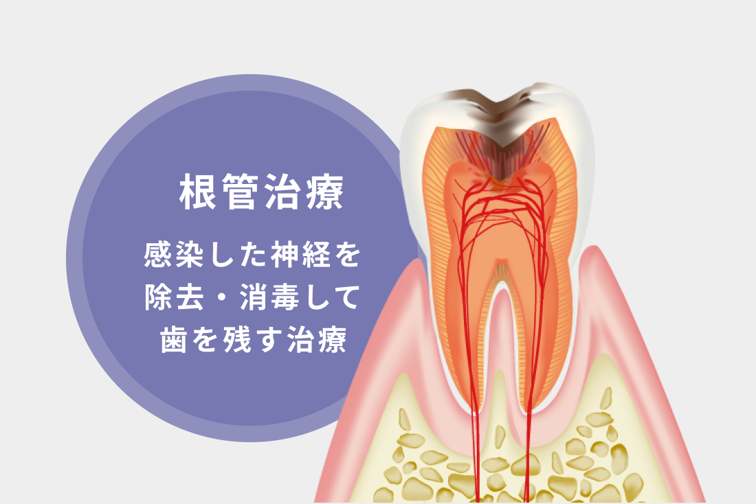 根管治療