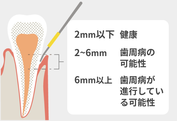 歯周ポケット検査